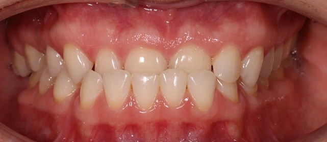 Лечение аномалии соотношений зубных дуг на брекет-системе